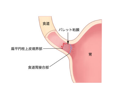 バレット食道について