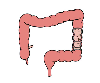 大腸がんのリスクは40代から上昇し始めます